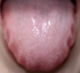 歯痕舌2
